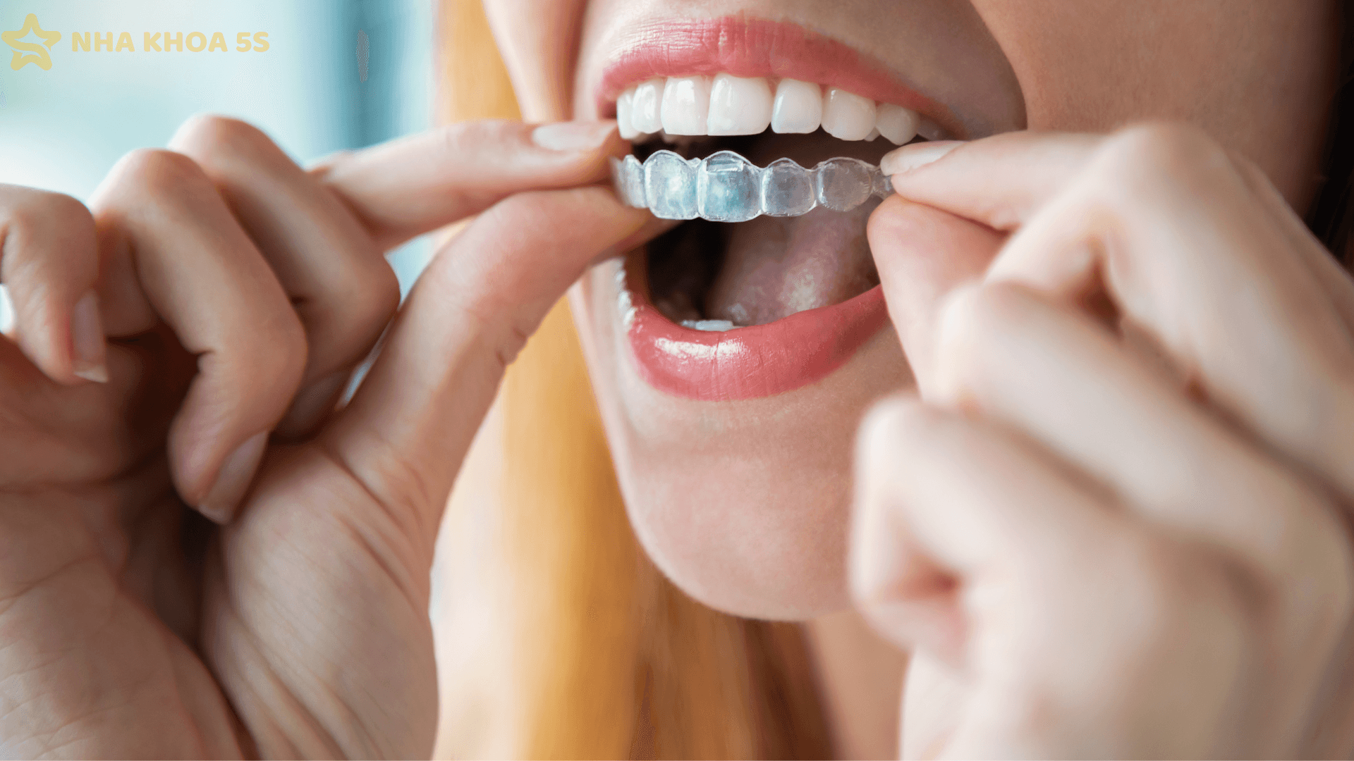 Niềng Invisalign Cho Răng Hô: Giải Pháp Chỉnh Nha Thẩm Mỹ, Kín Đáo Và Hiệu Quả Lâu Dài