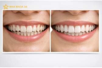 Nhược Điểm Niềng Invisalign: Sự Thật Cần Biết Trước Khi Lựa Chọn Năm 2026