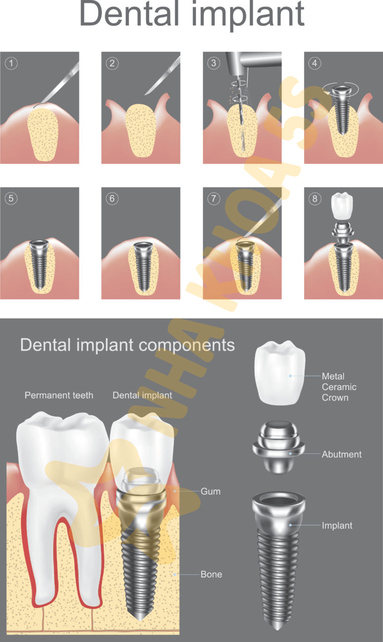 Implant Nha Khoa Mỹ Tho | Hướng Dẫn Đầy Đủ Về Cấy Ghép Implant An Toàn – Bền Vững