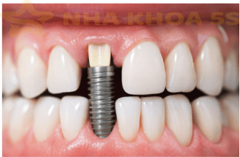 Implant Nha Khoa Mỹ Tho | Hướng Dẫn Đầy Đủ Về Cấy Ghép Implant An Toàn – Bền Vững