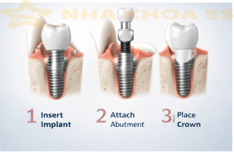 Implant Nha Khoa Mỹ Tho | Hướng Dẫn Đầy Đủ Về Cấy Ghép Implant An Toàn – Bền Vững