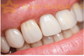 Implant Nha Khoa Mỹ Tho | Hướng Dẫn Đầy Đủ Về Cấy Ghép Implant An Toàn – Bền Vững