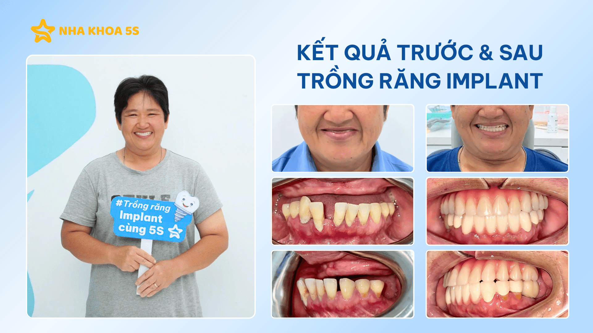 Nha Khoa 5S Đạt Top 10 Nha Khoa Trồng Răng Implant 2026 Việt Nam