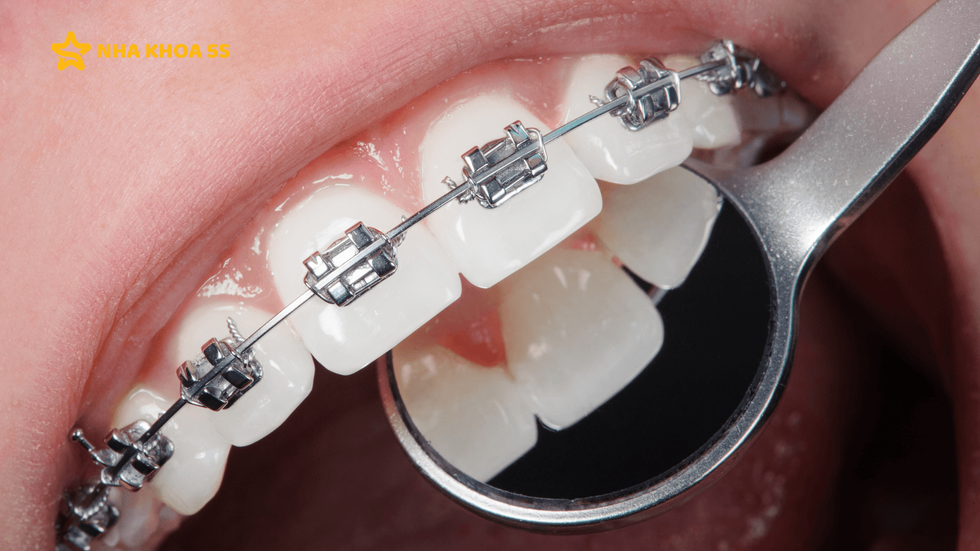 Nha Khoa Niềng Răng Uy Tín &Amp;#8211; Lựa Chọn Quan Trọng Quyết Định Kết Quả Điều Trị