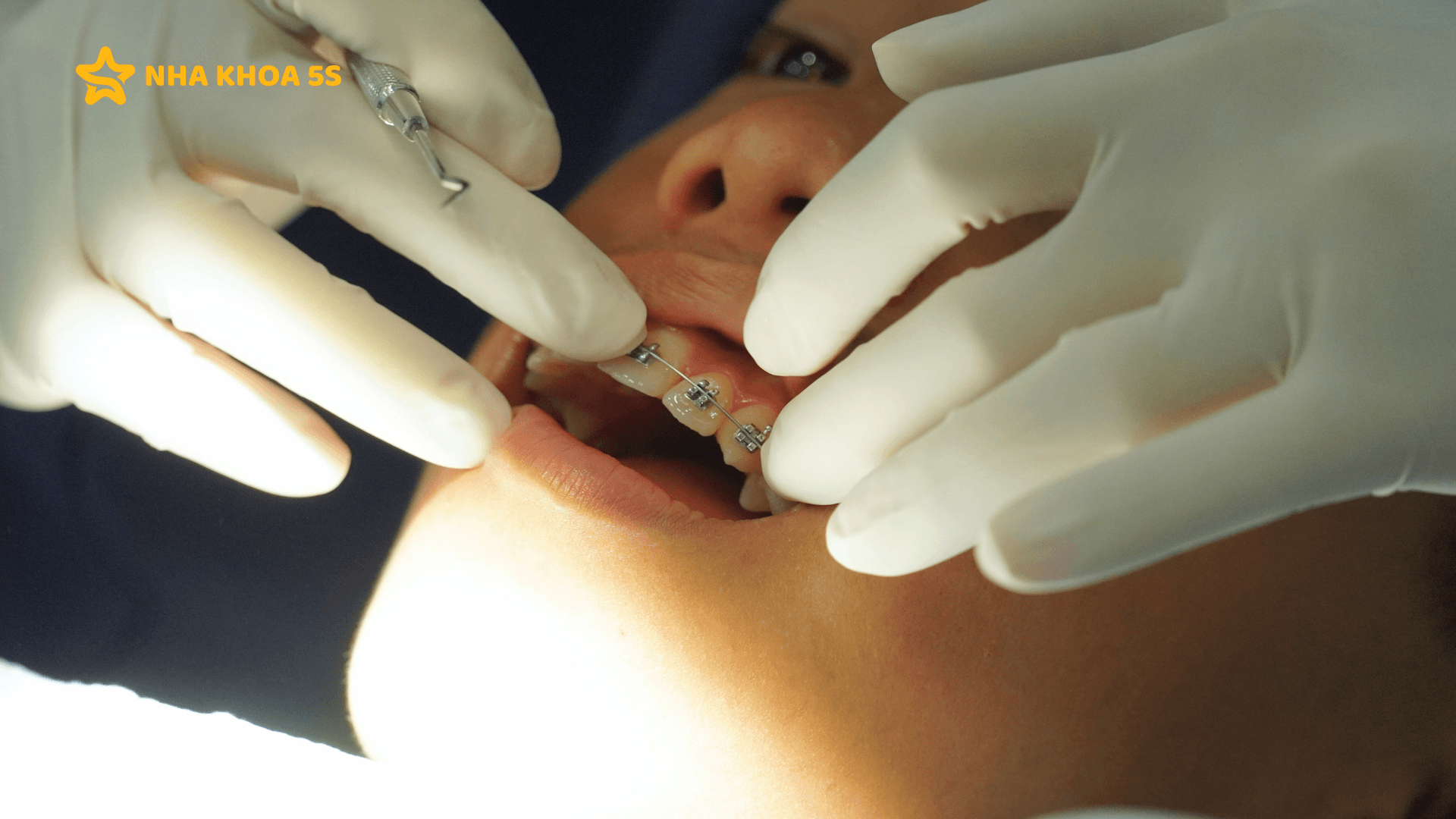 Nha Khoa Niềng Răng Uy Tín &Amp;#8211; Lựa Chọn Quan Trọng Quyết Định Kết Quả Điều Trị