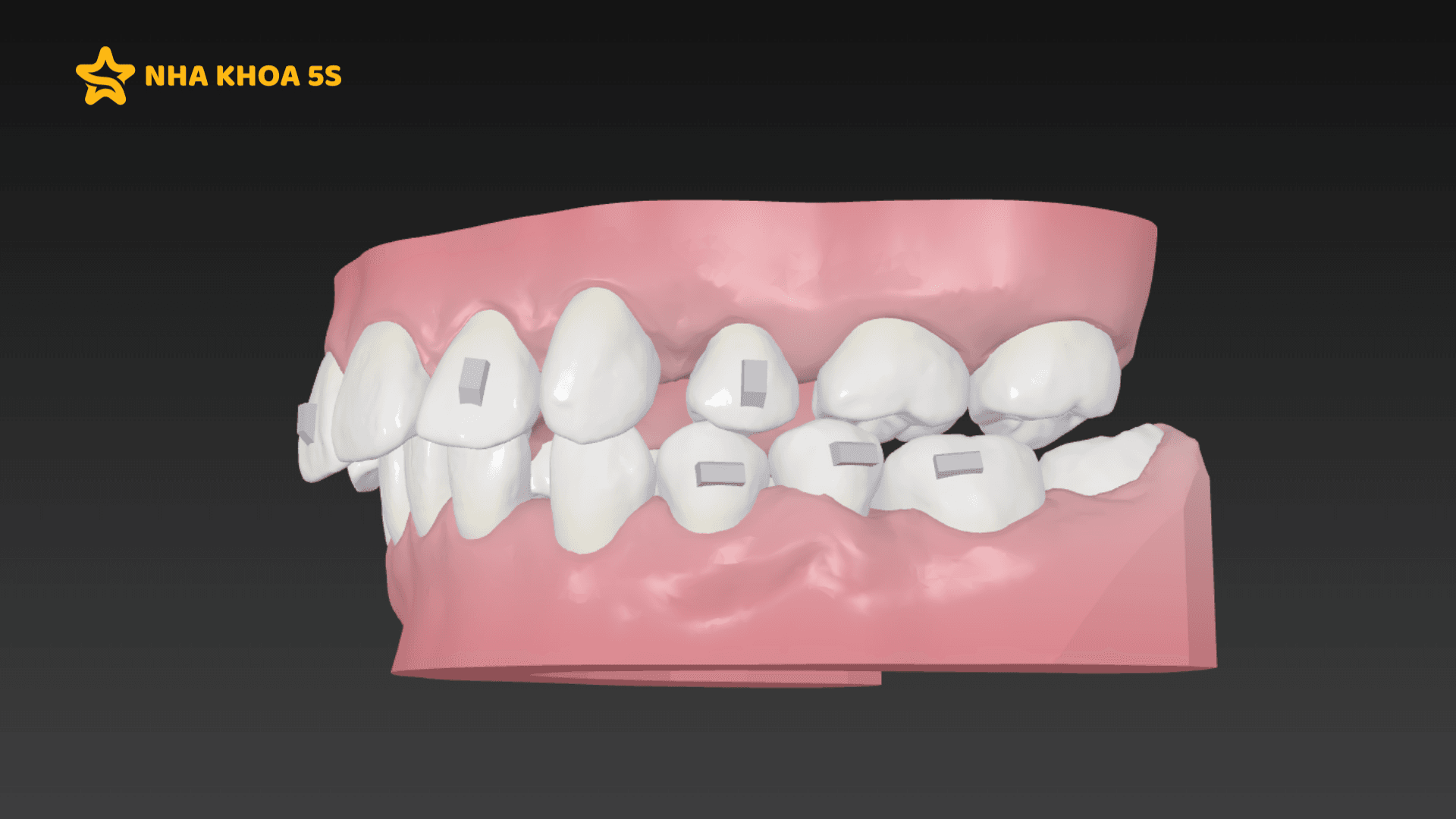 Nha Khoa Niềng Răng Uy Tín &Amp;#8211; Lựa Chọn Quan Trọng Quyết Định Kết Quả Điều Trị