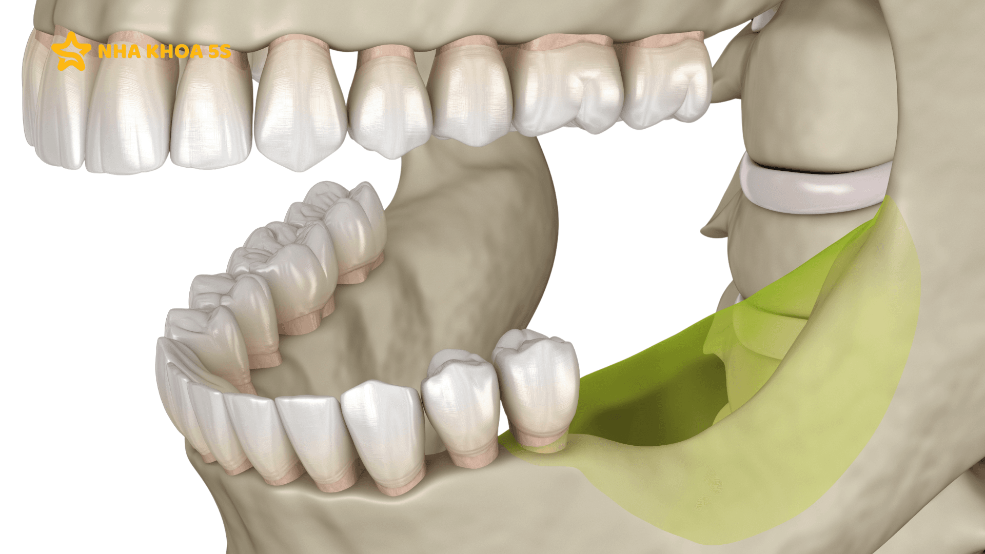 Nha Khoa Trồng Răng Implant Chuyên Sâu