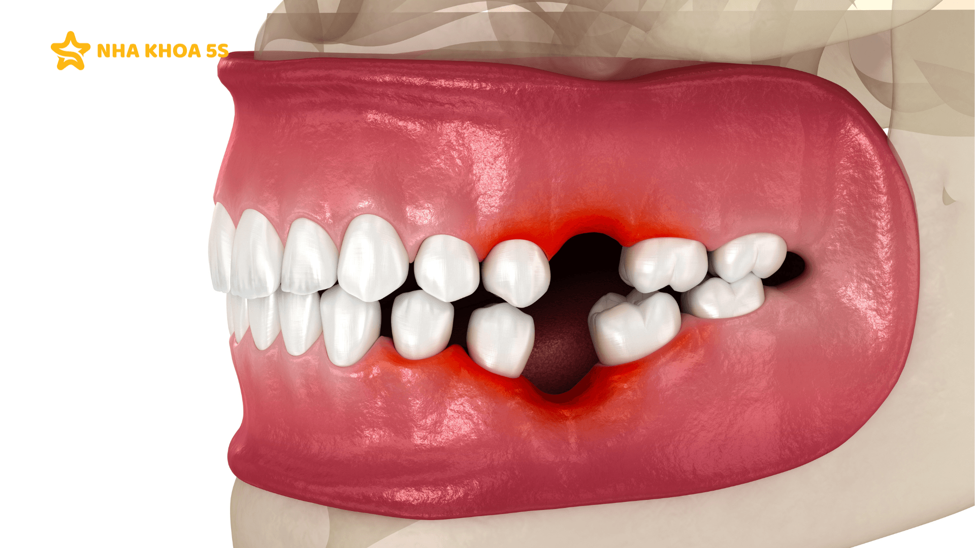 Nha Khoa Trồng Răng Implant Chuyên Sâu