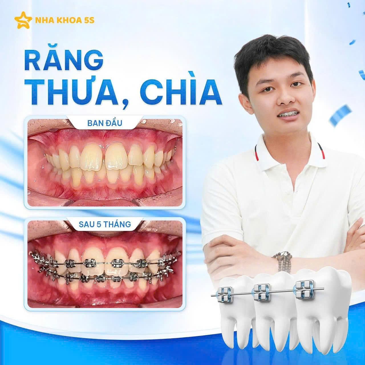 Khách Hàng Niềng Răng 3