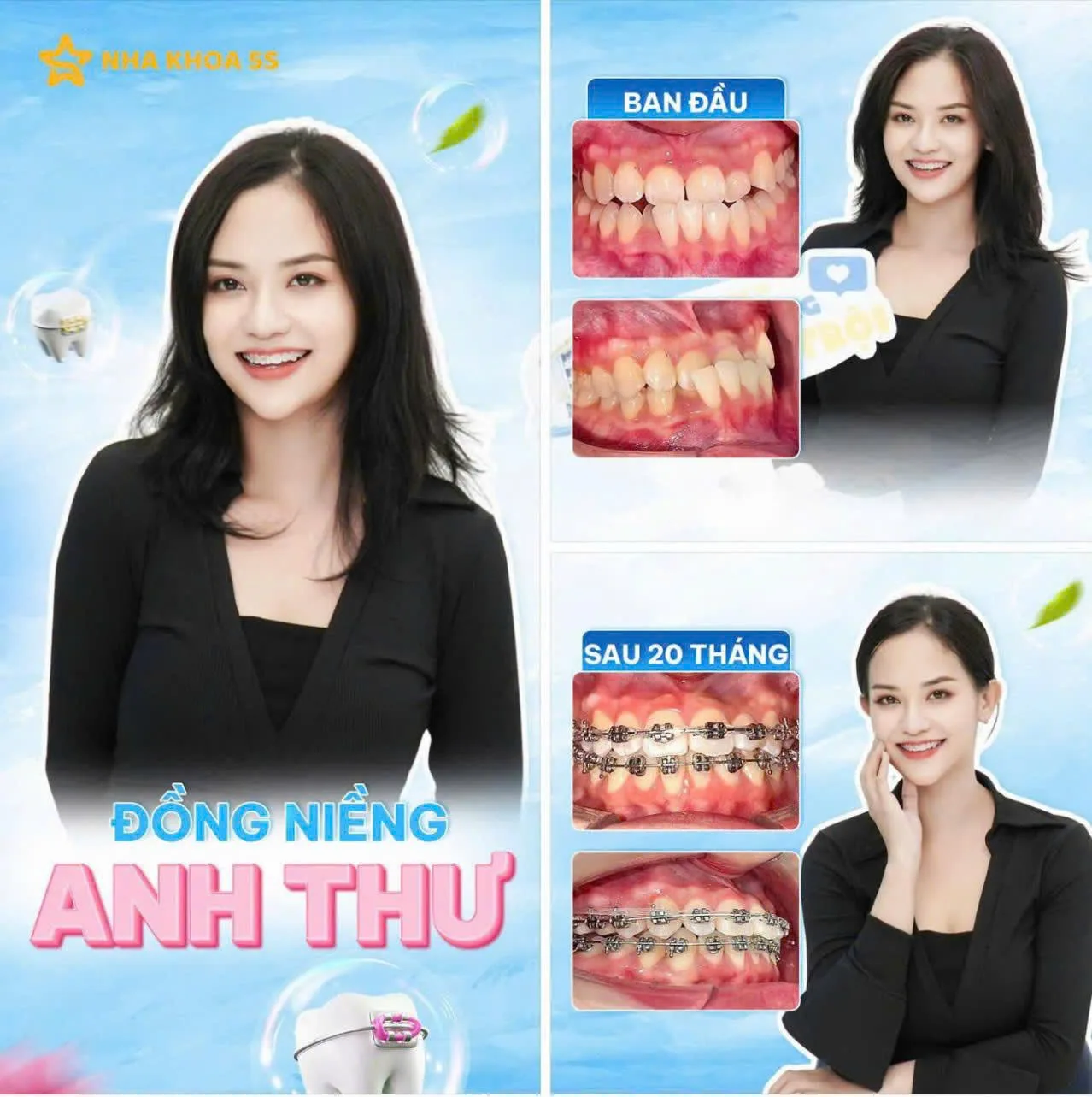 Khách Hàng Niềng Răng 4