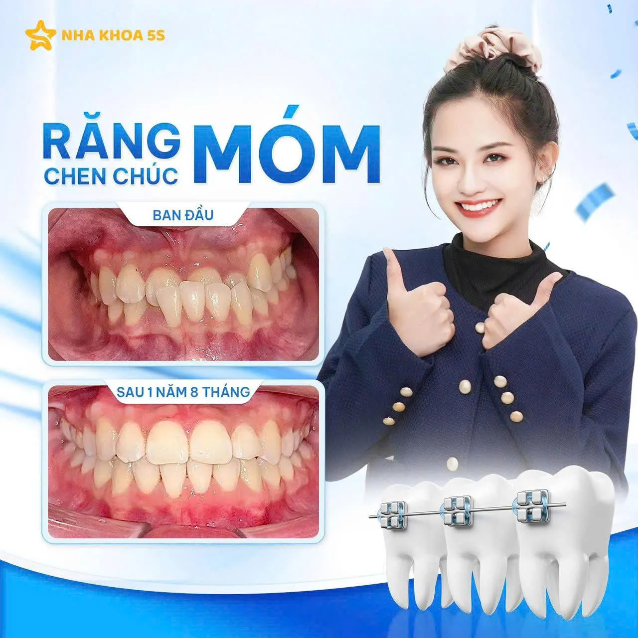 Khách Hàng Niềng Răng 8