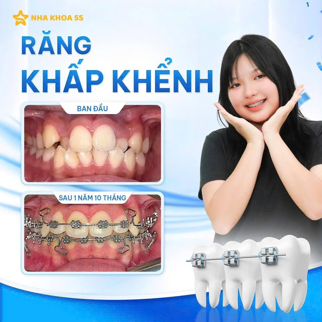 Khách Hàng Niềng Răng 5