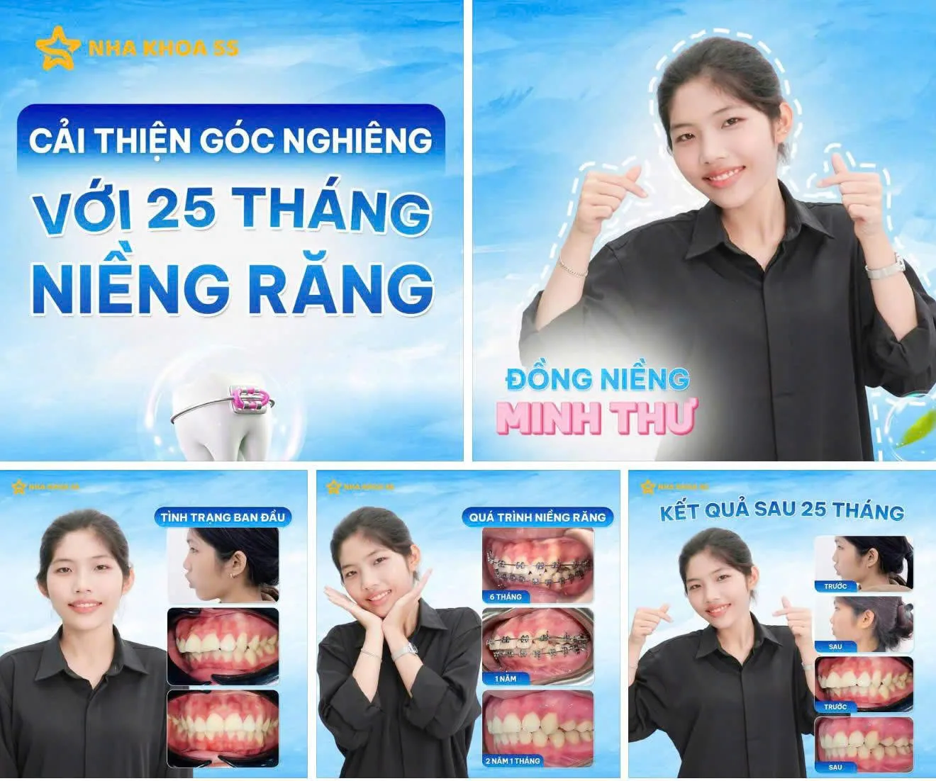 Khách Hàng Niềng Răng 6