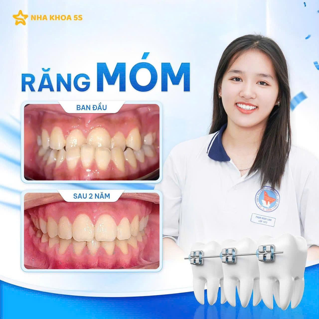 Khách Hàng Niềng Răng 9