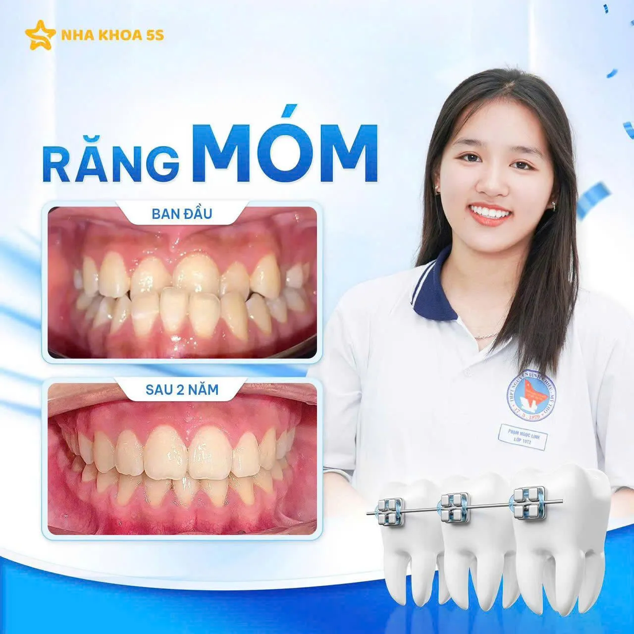 Khách Hàng Niềng Răng 9