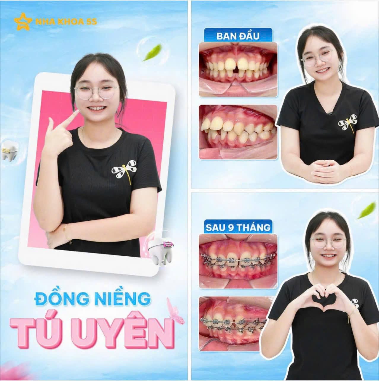 Khách Hàng Niềng Răng 10