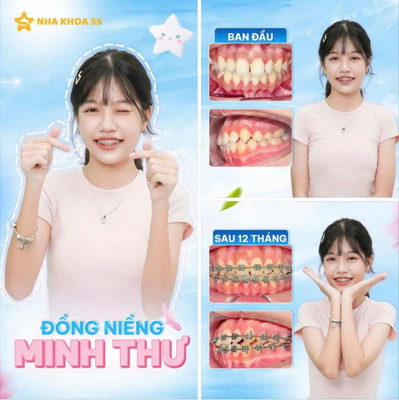 Khách Hàng Niềng Răng 12