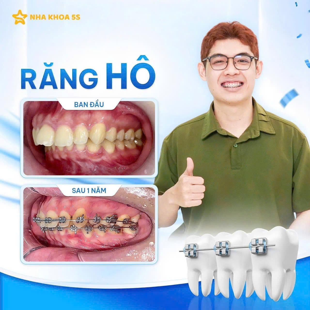 Khách Hàng Niềng Răng 14