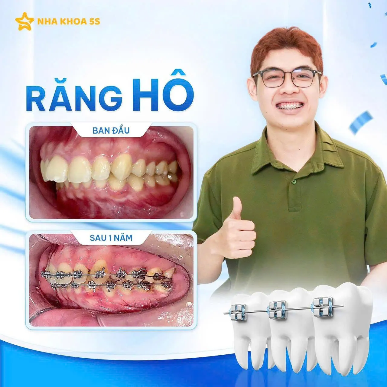 Khách Hàng Niềng Răng 14