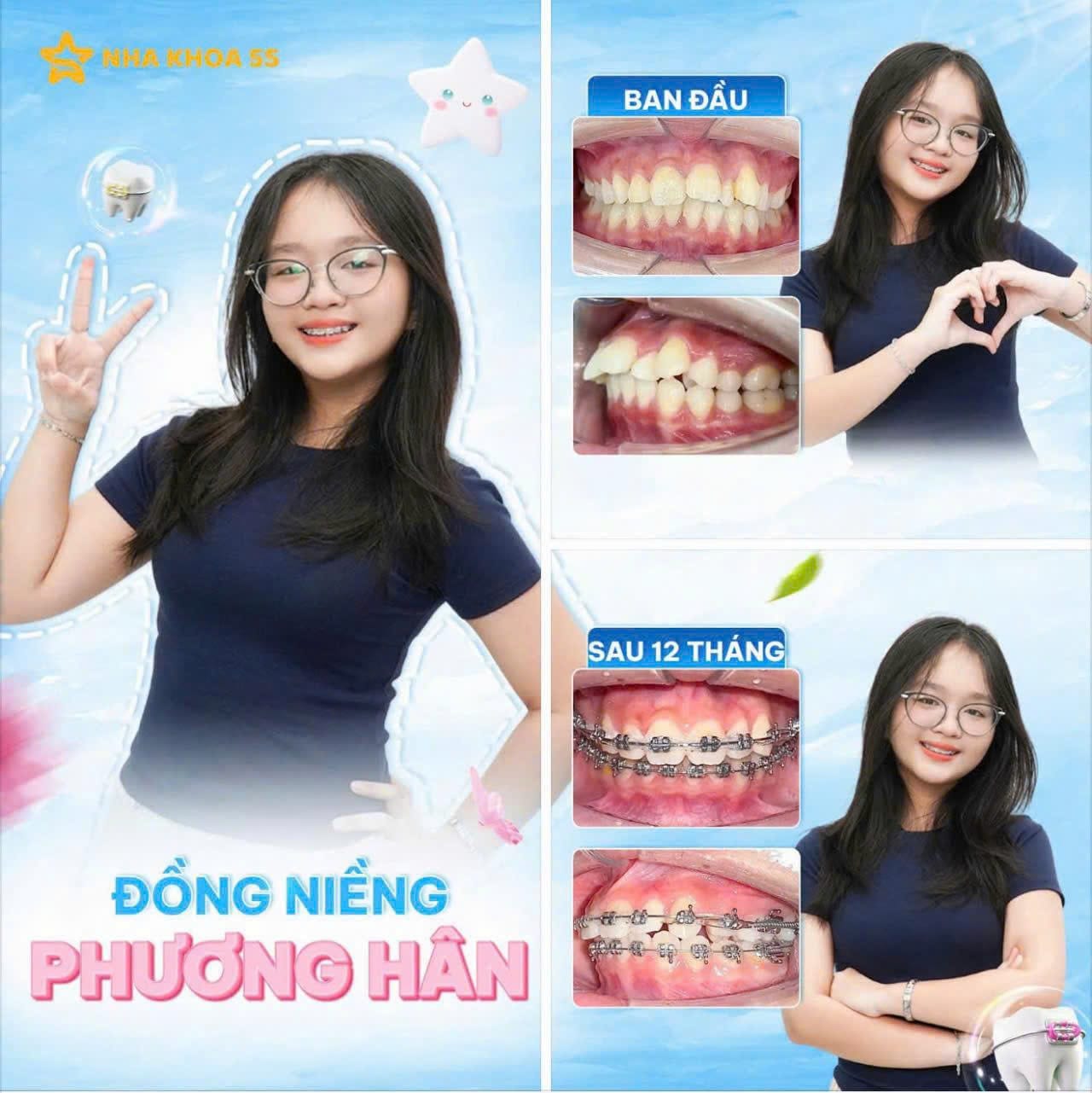 Khách Hàng Niềng Răng 16