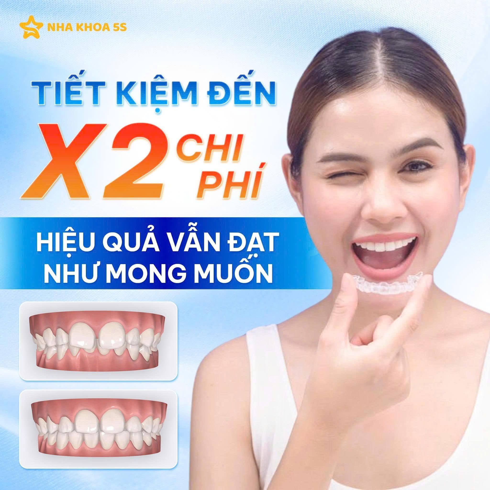 Niềng Răng Trong Suốt 5S