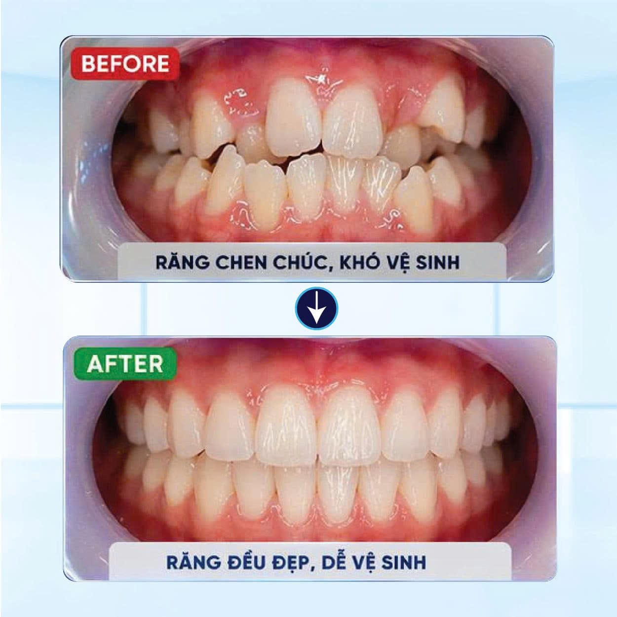 Kết Quả Niềng Răng Khách Hàng 7