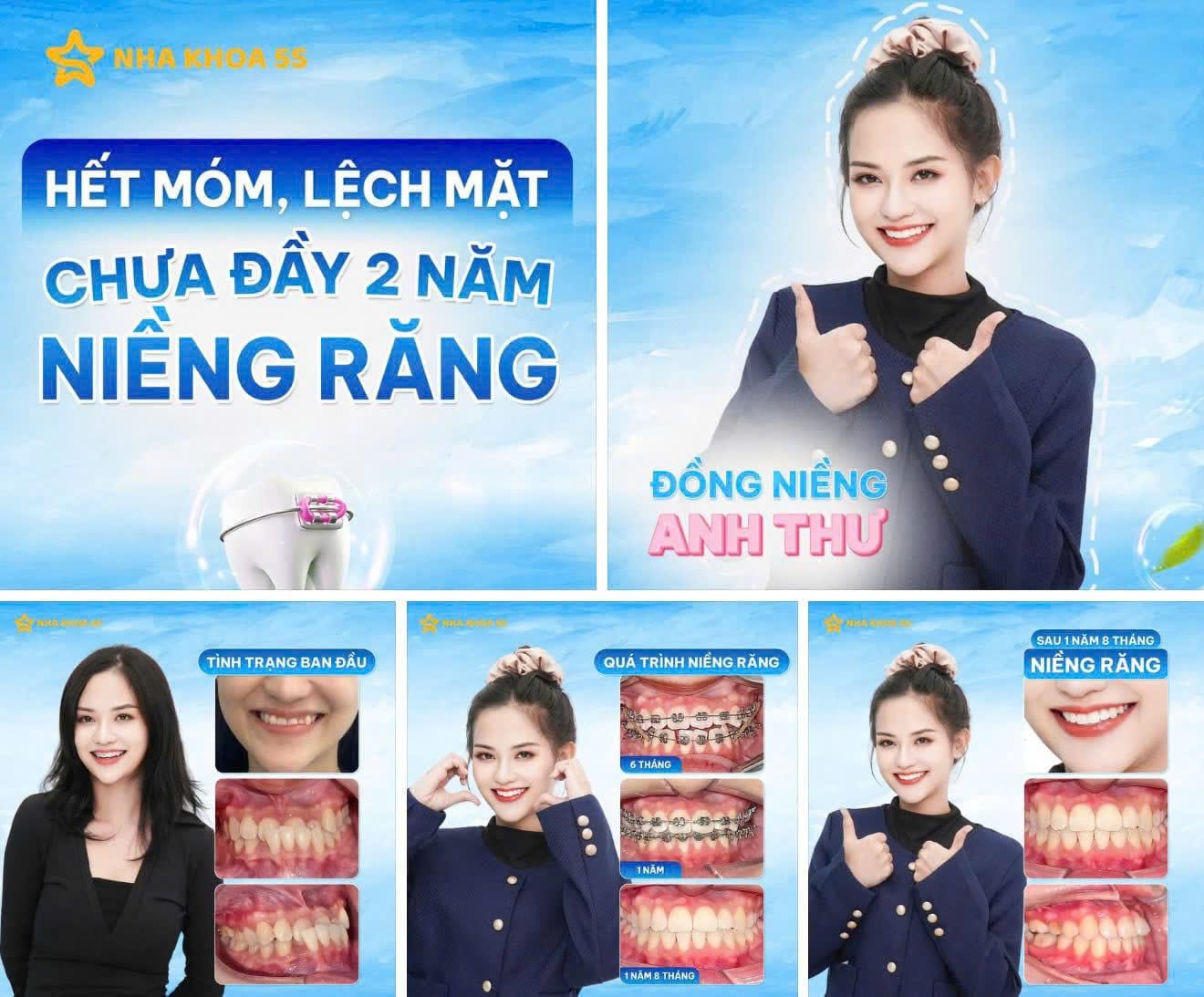 Khách Hàng Niềng Răng 17