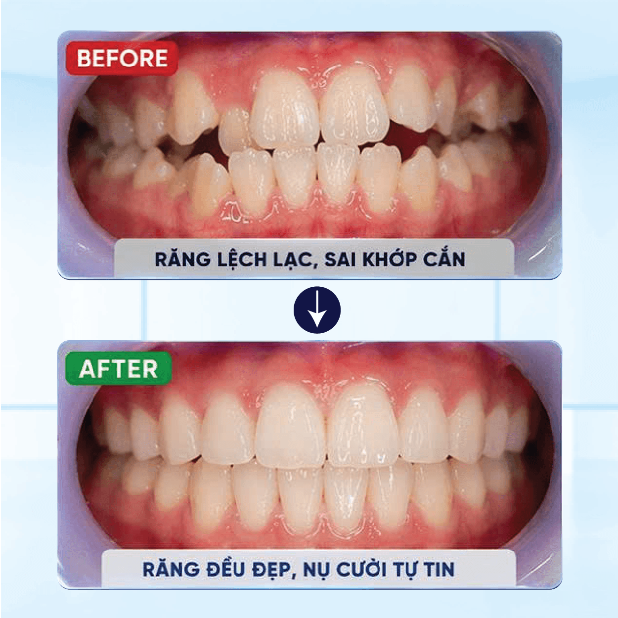 Kết Quả Niềng Răng Khách Hàng 3