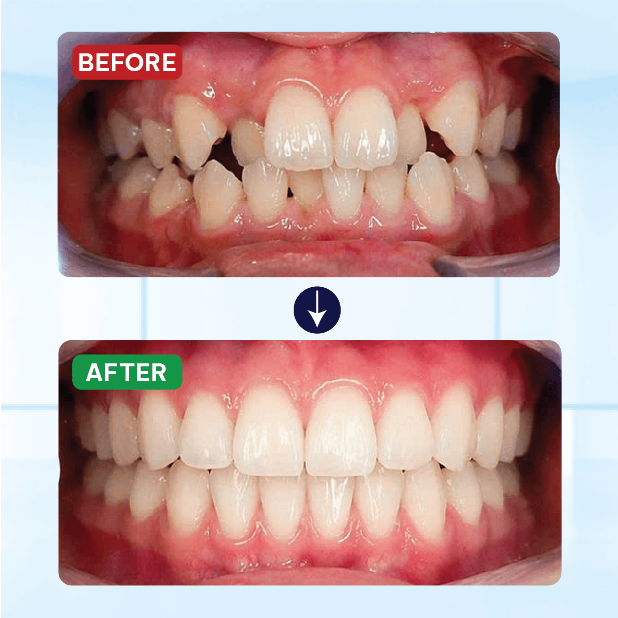 Kết Quả Niềng Răng Khách Hàng 5