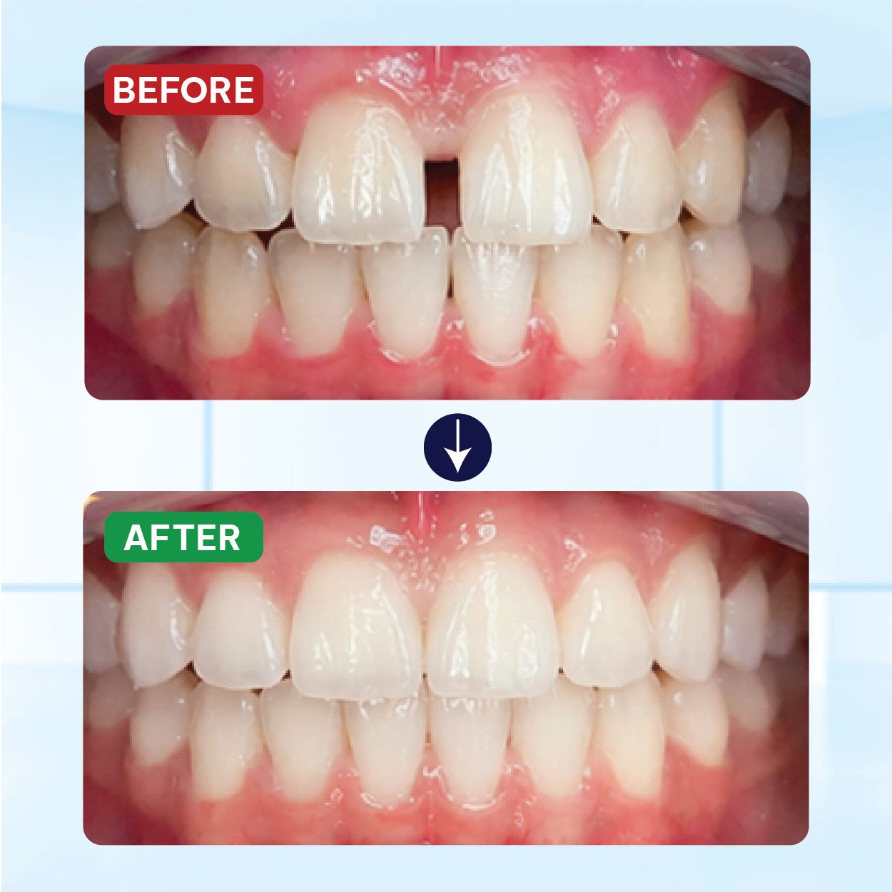 Kết Quả Niềng Răng Khách Hàng 6