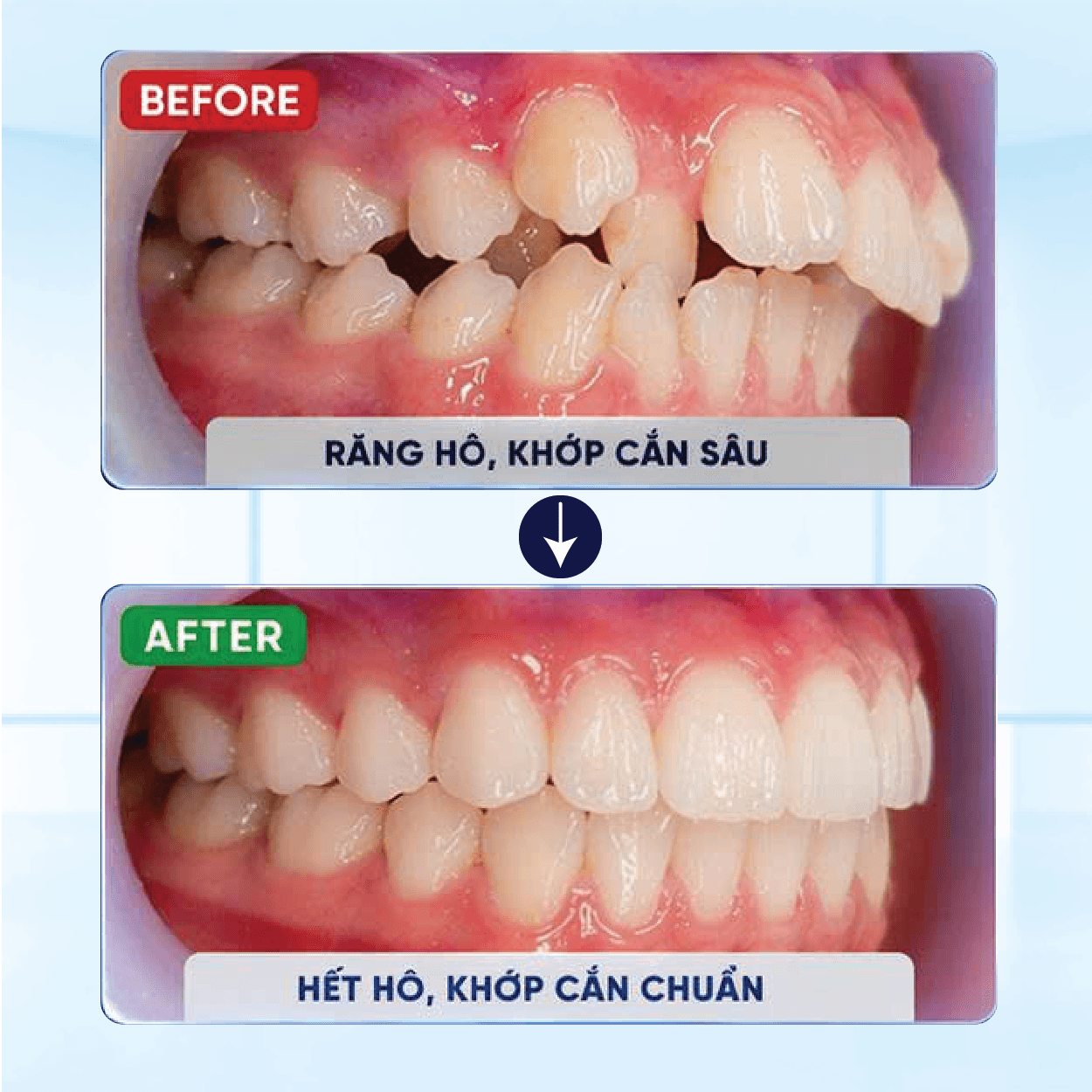 Kết Quả Niềng Răng Khách Hàng 2