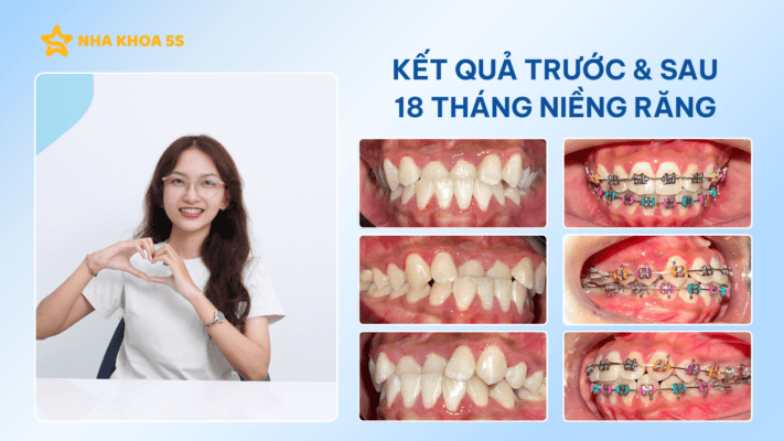 Nha Khoa 5S Vào Top 10 Thương Hiệu Nha Khoa Niềng Răng &Amp;Amp; Implant Việt Nam 2026