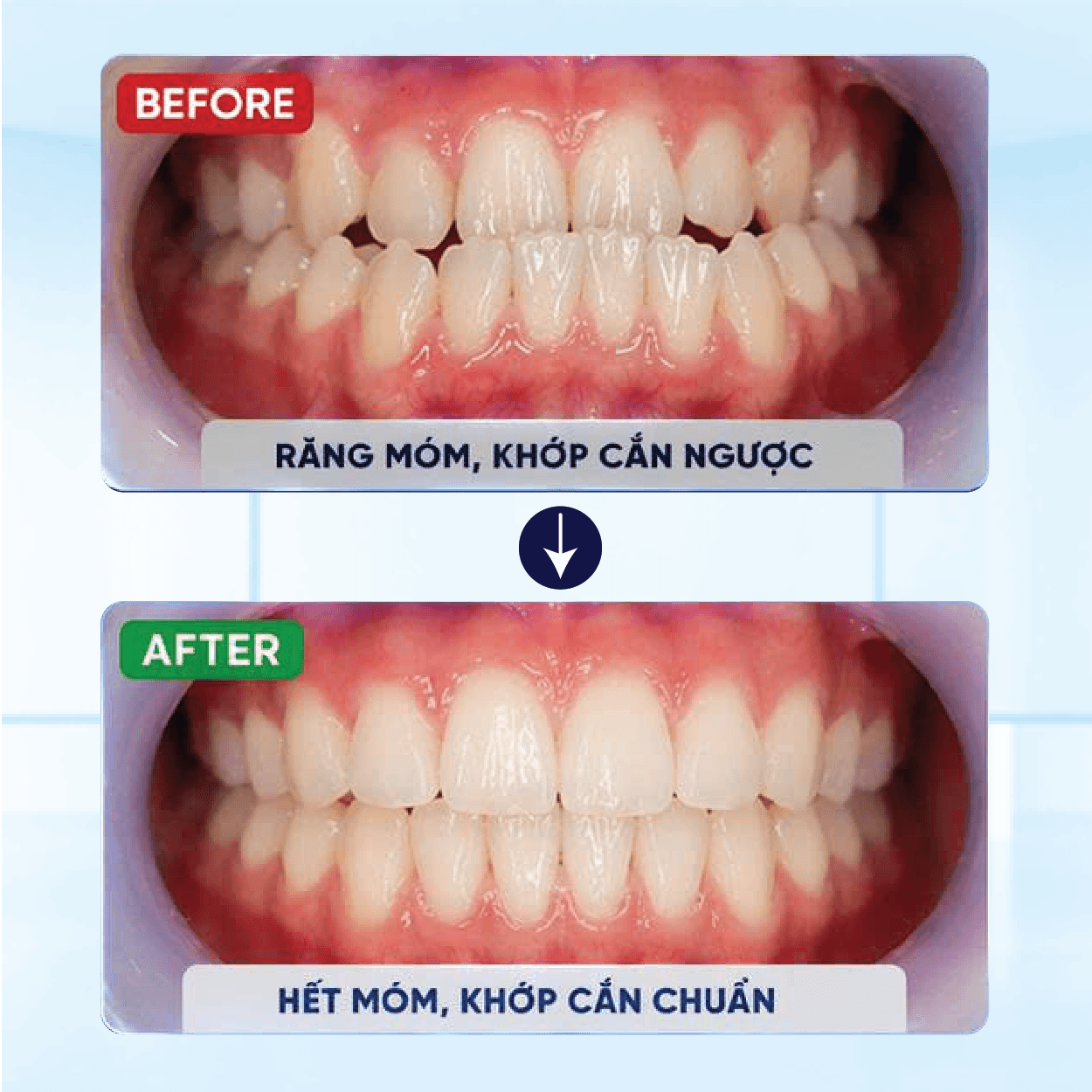 Kết Quả Niềng Răng Khách Hàng 4