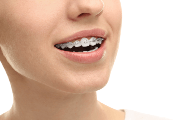 Niềng Răng Có Đau Không? Sự Thật Bạn Cần Biết Trước Khi Quyết Định (2026)