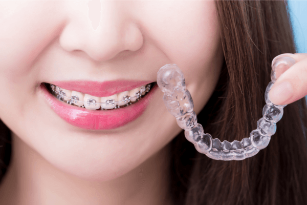 Niềng Răng Có Đau Không? Sự Thật Bạn Cần Biết Trước Khi Quyết Định (2026)