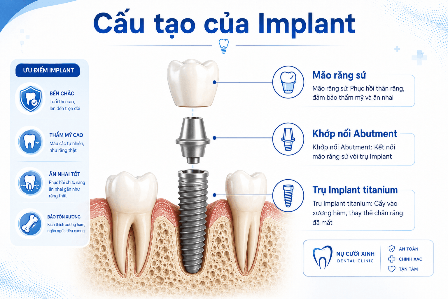 Cấu Tạo Của Implant: 3 Bộ Phận Tạo Nên Răng Implant Chắc Khỏe Và Thẩm Mỹ