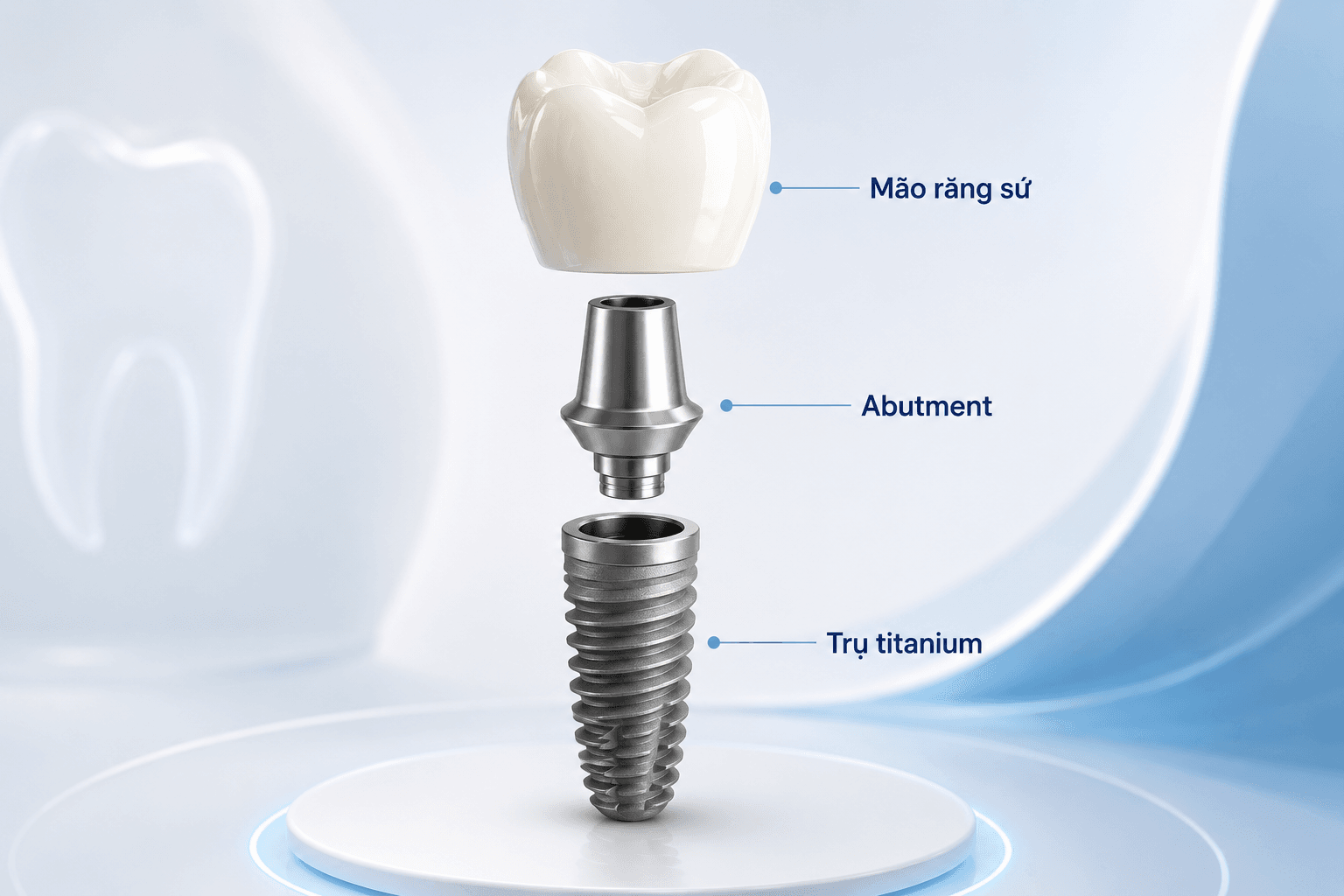 Cấu Tạo Của Implant: 3 Bộ Phận Tạo Nên Răng Implant Chắc Khỏe Và Thẩm Mỹ