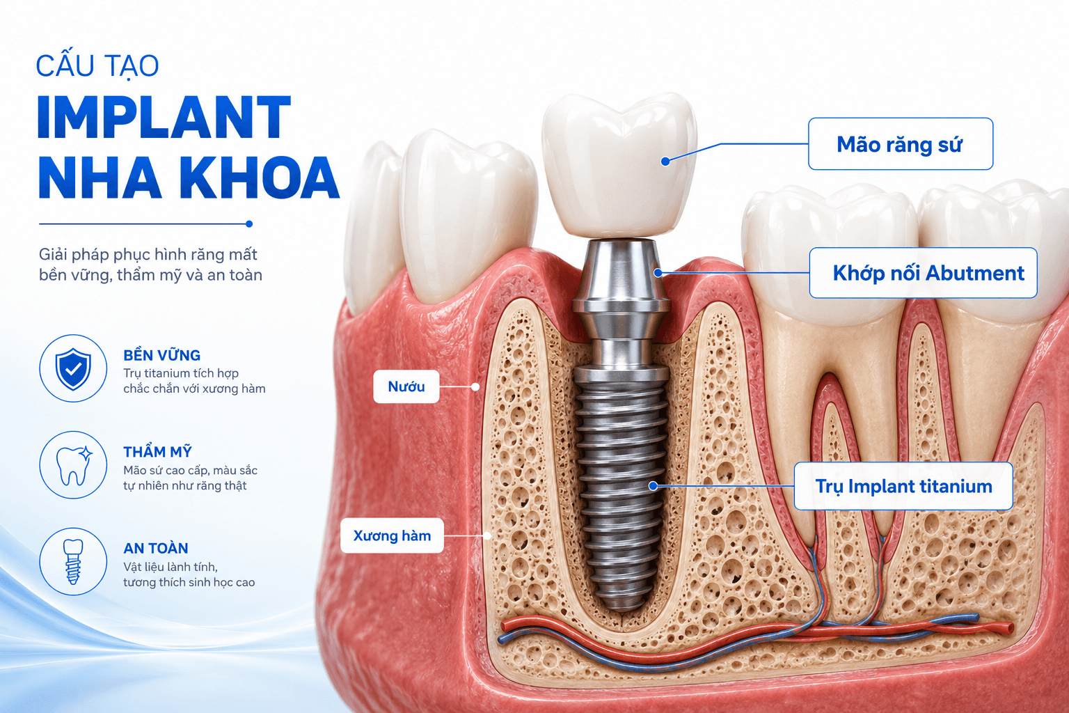 Cấu Tạo Của Implant: 3 Bộ Phận Tạo Nên Răng Implant Chắc Khỏe Và Thẩm Mỹ