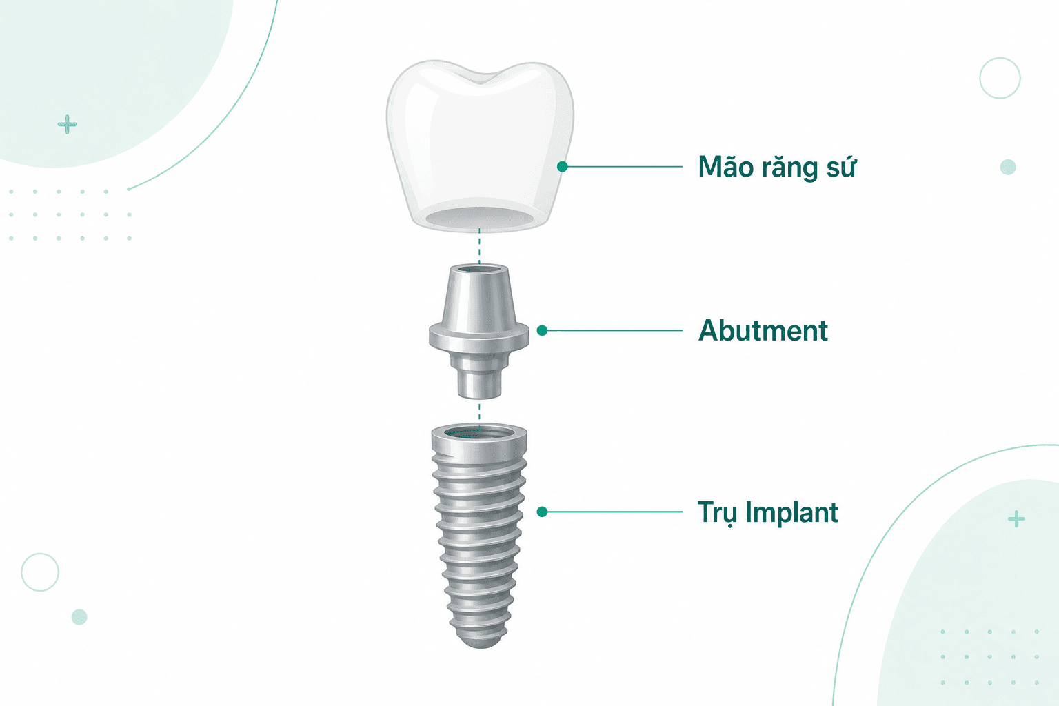 Cấu Tạo Của Implant: 3 Bộ Phận Tạo Nên Răng Implant Chắc Khỏe Và Thẩm Mỹ