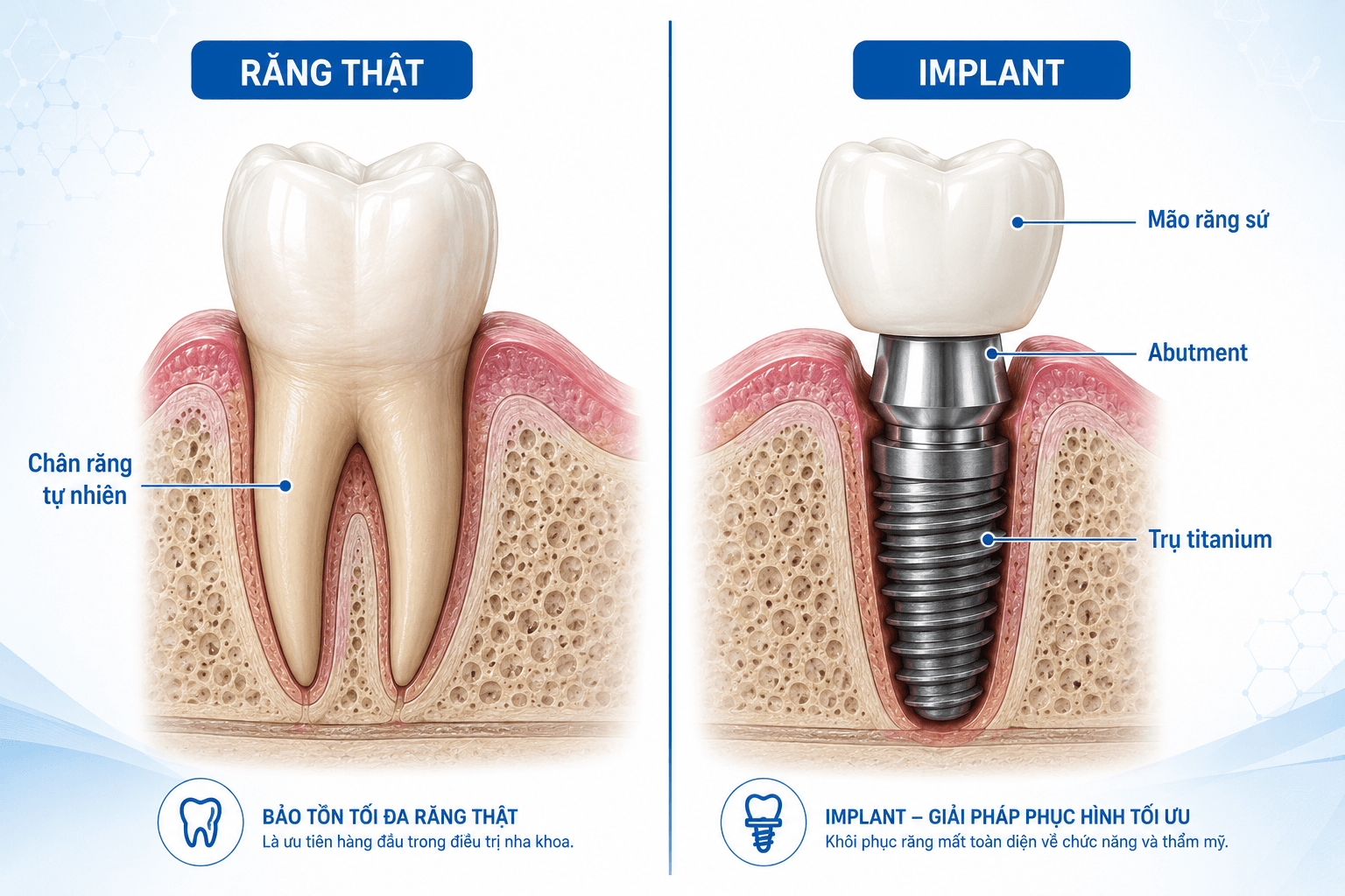 Cấu Tạo Của Implant: 3 Bộ Phận Tạo Nên Răng Implant Chắc Khỏe Và Thẩm Mỹ