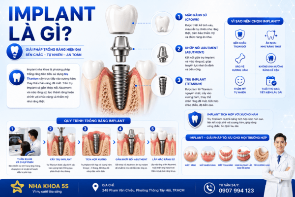 Implant Là Gì? Tìm Hiểu Chi Tiết Về Cấy Ghép Implant Trong Nha Khoa