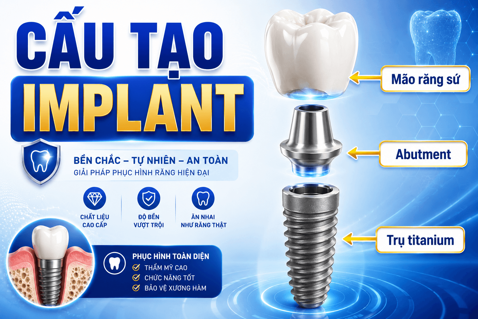 Cấu Tạo Của Implant: 3 Bộ Phận Tạo Nên Răng Implant Chắc Khỏe Và Thẩm Mỹ