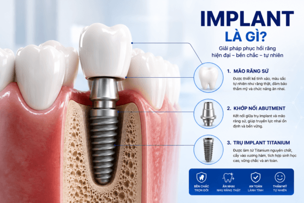 Implant Là Gì? Tìm Hiểu Chi Tiết Về Cấy Ghép Implant Trong Nha Khoa