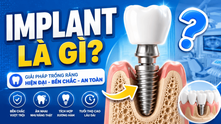 Implant Là Gì?
