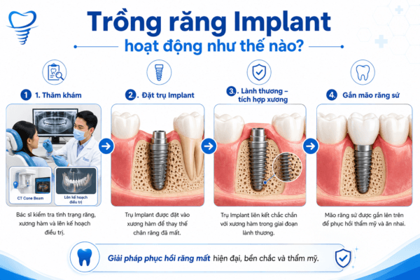 Trồng Răng Implant Hoạt Động Như Thế Nào? Trồng Răng Implant Hoạt Động Như Thế Nào?