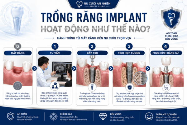 Trồng Răng Implant Hoạt Động Như Thế Nào? Trồng Răng Implant Hoạt Động Như Thế Nào?