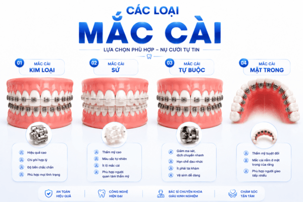 Các Loại Mắc Cài Phổ Biến Hiện Nay – Nên Chọn Loại Nào Tốt Nhất? Các Loại Mắc Cài Phổ Biến Hiện Nay – Nên Chọn Loại Nào Tốt Nhất?