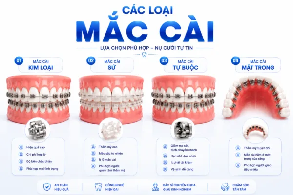 Các Loại Mắc Cài Phổ Biến Hiện Nay – Nên Chọn Loại Nào Tốt Nhất?