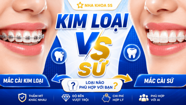 Mắc Cài Kim Loại Vs Sứ