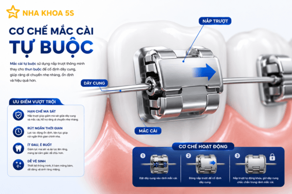 Niềng Răng Mắc Cài Tự Buộc Là Gì? Ưu Nhược Điểm Và Những Điều Cần Biết Trước Khi Chỉnh Nha Niềng Răng Mắc Cài Tự Buộc Là Gì? Ưu Nhược Điểm Và Những Điều Cần Biết Trước Khi Chỉnh Nha